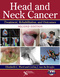 Head and Neck Cancer, Treatment, Rehabilitation, and Outcomes